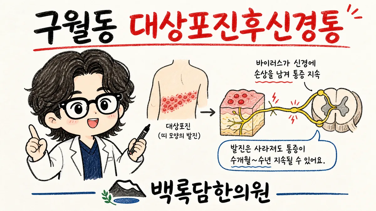 구월동 대상포진후신경통, 치료 받아도 자꾸 도져서 찾아오는 통증
