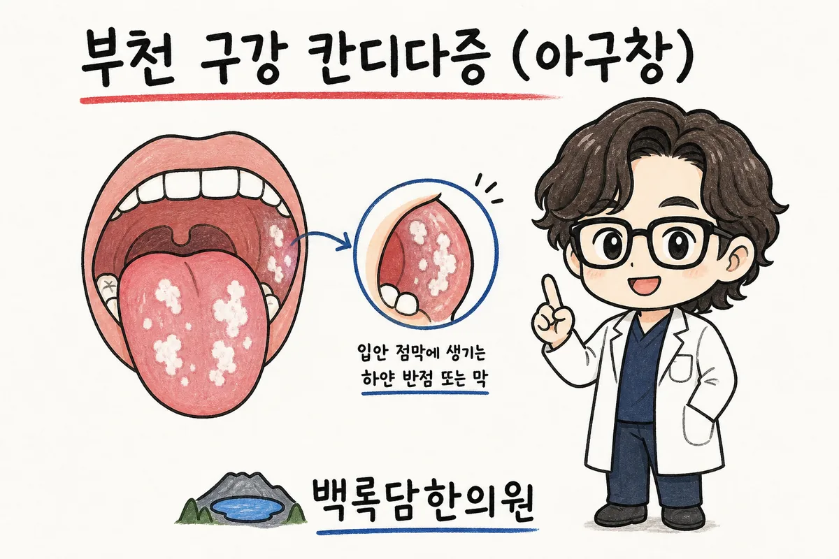 부천 구강 칸디다증, 입안 하얀 막이 지워지지 않고 따가워서 밥맛이 없을 때