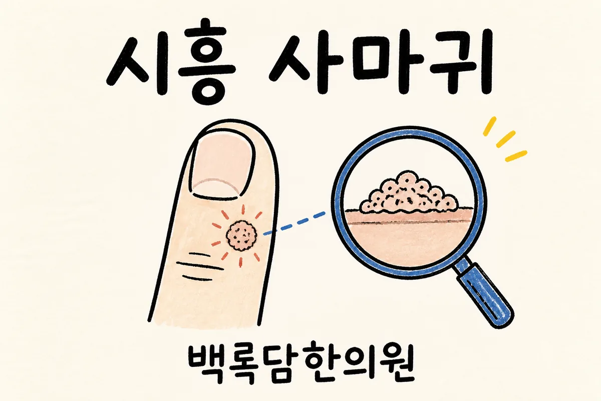 시흥 물사마귀, 손가락에 난 작은 혹이 자꾸 번지고 떨어지지 않을 때