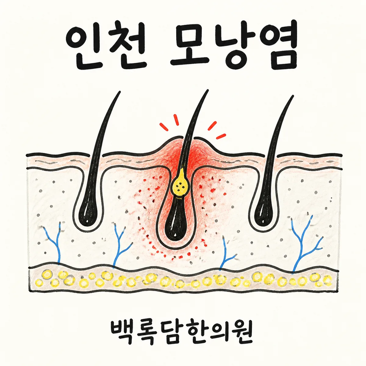 인천 모낭염, 검사는 정상이라는데 좁쌀 같은 염증이 계속 올라올 때