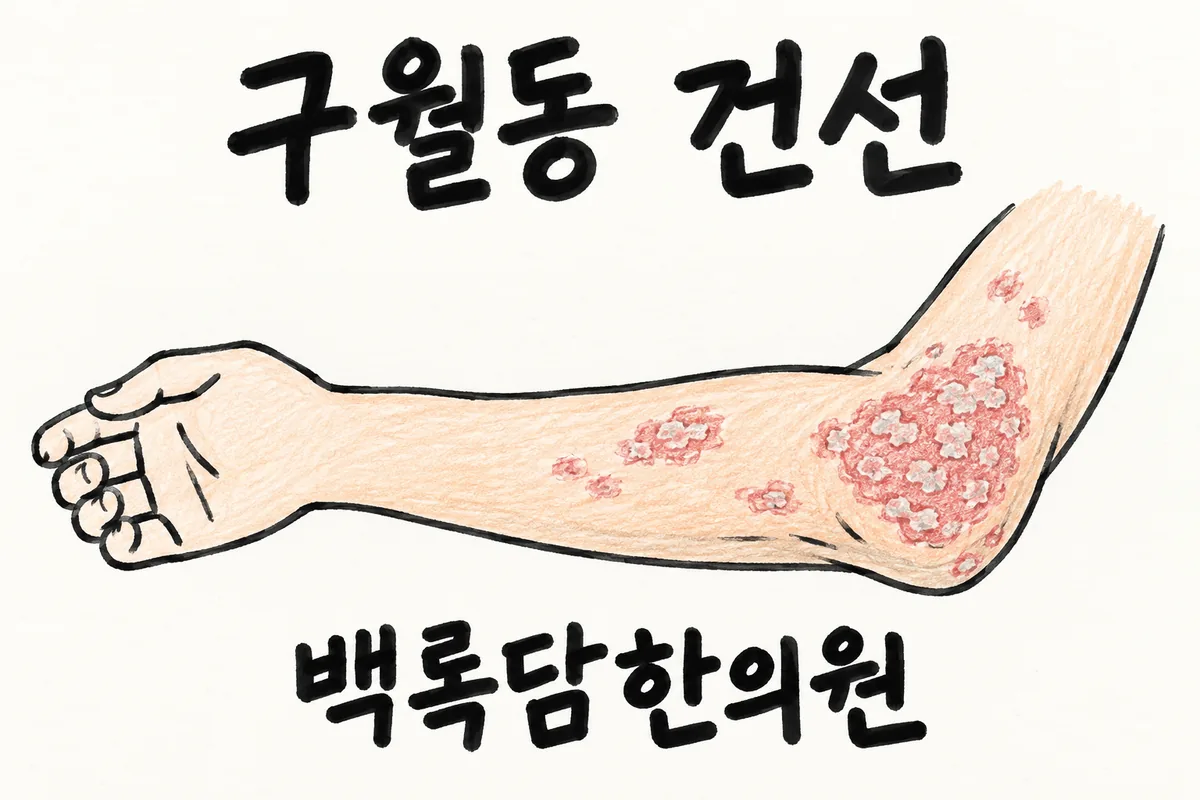 구월동 건선, 검사는 정상인데 피부에 하얀 비늘이 자꾸 올라올 때