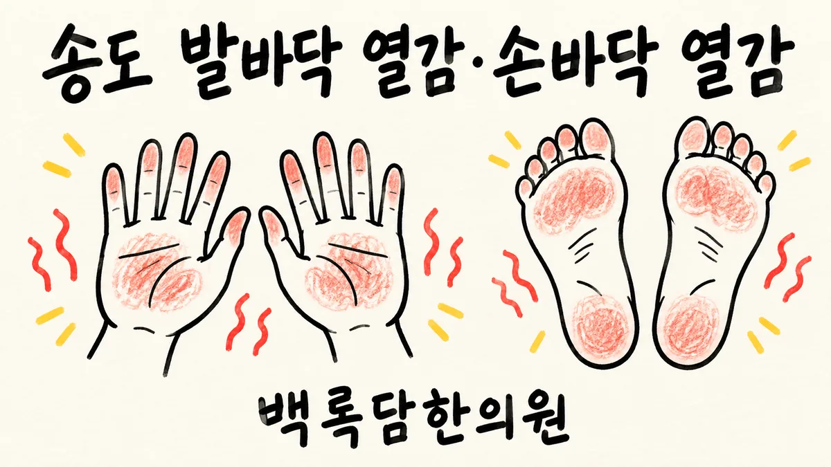 송도 발바닥 열감 손바닥 열감, 검사는 정상인데 밤마다 손발이 화끈거릴 때