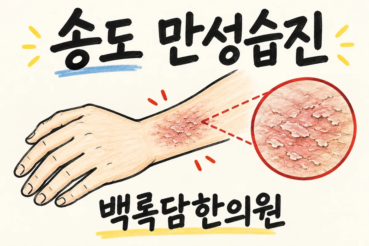 송도 만성습진, 연고 발라도 잠깐이고 또 도지는 가려운 피부