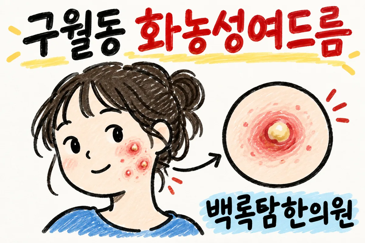구월동 화농성여드름, 치료해도 자꾸 같은 자리에 또 올라올 때